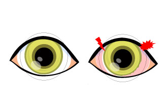 dry eye myopia thumbnail.jpg